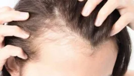 Médicos alertam que Covid-19 está aumentando queda de cabelo em pacientes.
