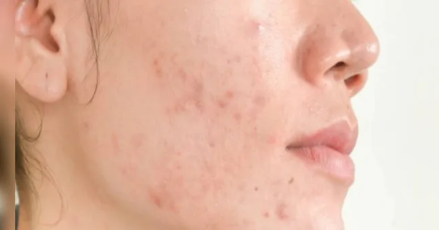 Imagem ilustrativa da notícia Acne: fatores psicológicos e comportamentais podem desencadear inflamação