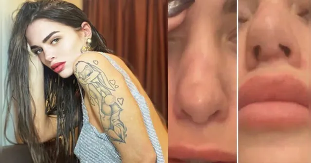 Imagem ilustrativa da notícia Modelo diz que seu nariz está 'apodrecendo' após plástica