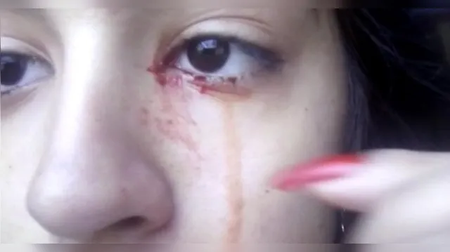Imagem ilustrativa da notícia Menina de 12 anos ‘chora sangue’ e intriga médicos