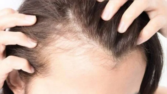 Imagem ilustrativa da notícia Queda de cabelo atinge 30% dos pacientes no pós-covid