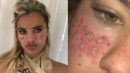 A jovem Tilly Whitfeld tentou fazer em casa uma acupuntura facial, com base em um passo a passo postado na rede social.