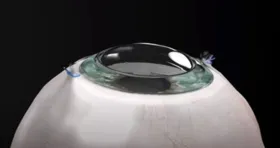 Córnea artificial Kpro integra-se à parede ocular
