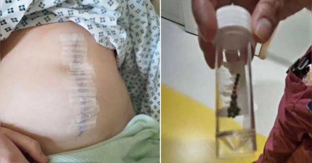 Imagem ilustrativa da notícia Jovem perde parte do intestino após desafio do TikTok