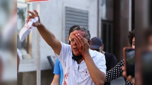 Imagem ilustrativa da notícia Bala de borracha: Homem não estava em protesto e perde olho