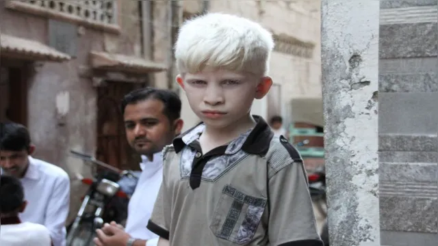 Imagem ilustrativa da notícia Albinismo: entenda a condição genética da falta de melanina
