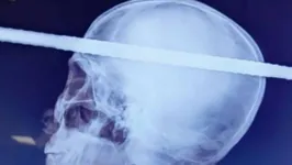 Exame de imagem do paciente mostra a barra de ferro atravessada em seu crânio