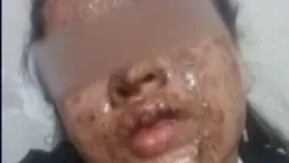 A jovem teve o rosto completamente desfigurado durante um assalto