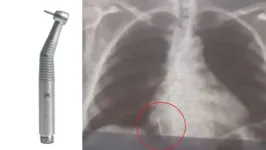 Objeto acabou parando no pulmão de uma paciente após se soltar do equipamento