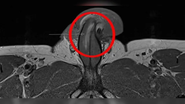Imagem ilustrativa da notícia Homem quebra o pênis de forma vertical em caso raro