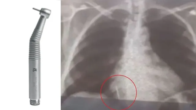 Imagem ilustrativa da notícia Broca de dentista se solta e vai parar no pulmão de paciente