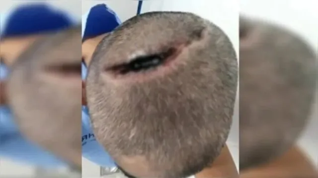 Imagem ilustrativa da notícia Imagem forte: homem acorda com cabeça rachada após intubação