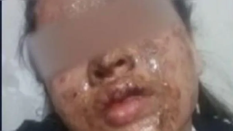 Imagem ilustrativa da notícia Assalto: mulher é atacada com ácido e tem rosto desfigurado 