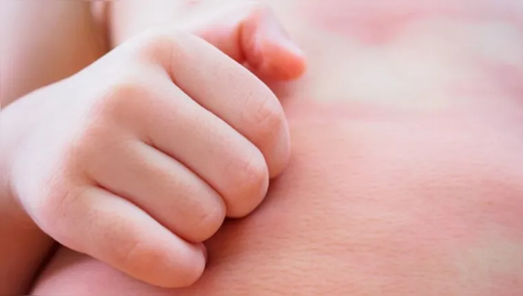 Imagem ilustrativa da notícia Alergias: como evitar o surgimento na pele do bebê