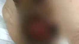 O idoso foi encontrado com desidratação, larvas em lesões em um ferimento no corpo.