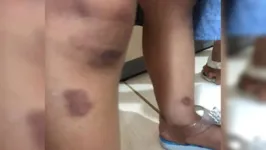 A bebê foi encontrada com diversas queimaduras e hematomas pelo corpo