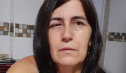 Regina Amorim se recupera após ter os olhos colados por supercola
