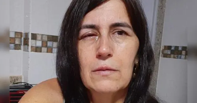 Imagem ilustrativa da notícia Mulher confunde colírio com cola e vai parar no hospital