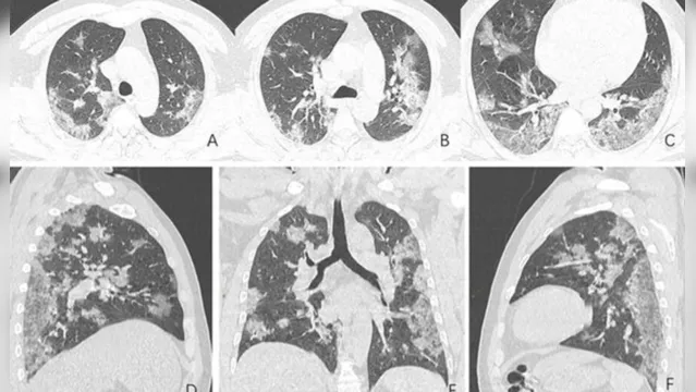 Imagem ilustrativa da notícia Siga alerta! Covid-19 afeta pulmões de diversas formas