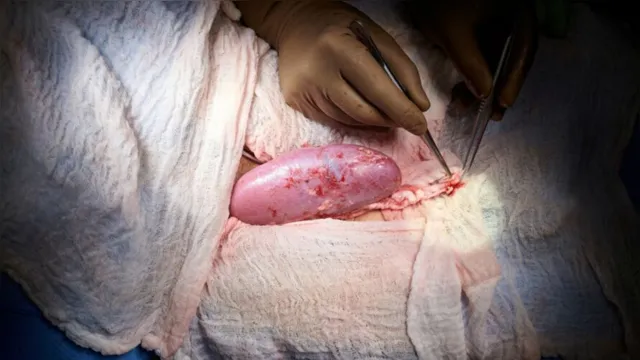 Imagem ilustrativa da notícia Mulher recebe rim de porco em transplante realizado nos EUA