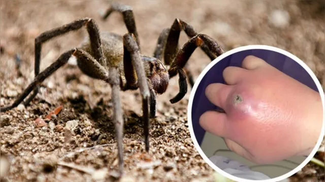 Imagem ilustrativa da notícia Picada de aranha deixa mulher com mão "de luva de boxe"
