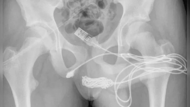 Imagem ilustrativa da notícia Que dor! Jovem enfia cabo USB na uretra após medir pênis