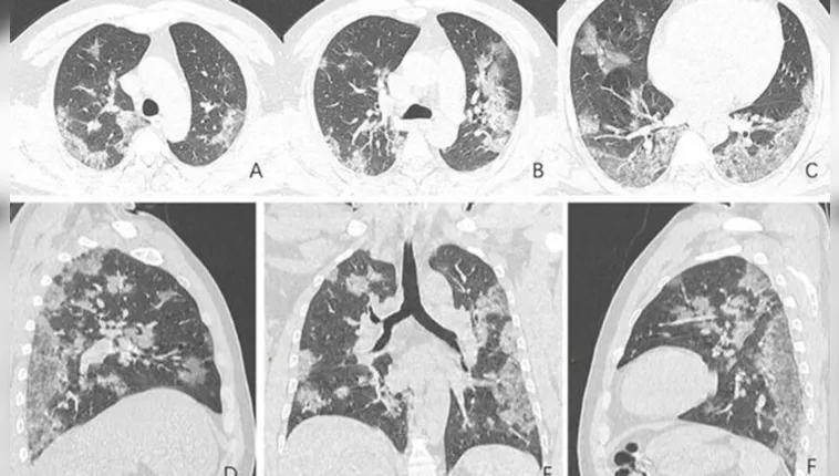 Imagem ilustrativa da notícia Siga alerta! Covid-19 afeta pulmões de diversas formas