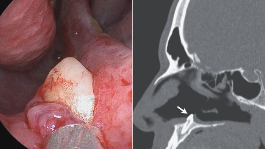 A estrutura encontrada no nariz do paciente acabou removida por meio de cirurgia.