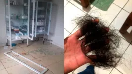A mulher usou de tanta violência que arrancou tufos de cabelo da enfermeira