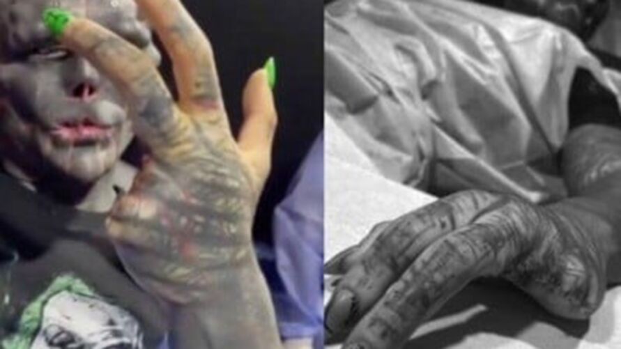 Imagem ilustrativa da notícia: Para ficar igual a 'alien', homem retira dois dedos