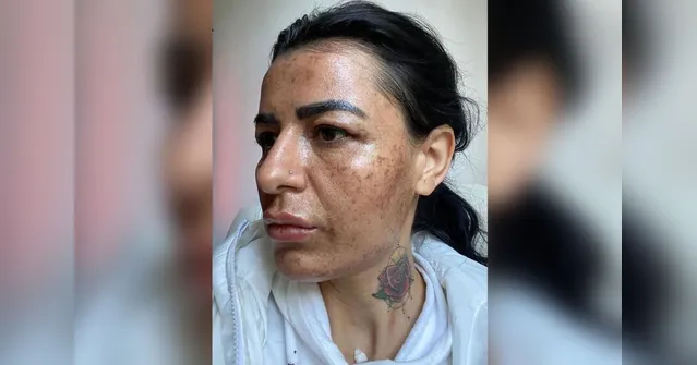 Imagem ilustrativa da notícia Esteticista se distrai com celular e cliente fica deformada 