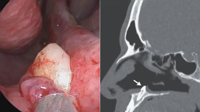 Imagem ilustrativa da notícia Médicos retiram dente do nariz de homem com falta de ar