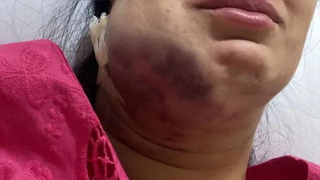 Imagem ilustrativa da notícia Lipo papada: médica fica com rosto deformado após erro 