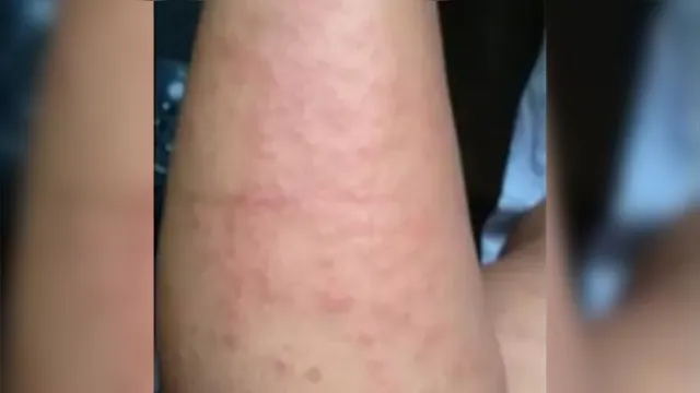 Imagem ilustrativa da notícia Doença que causa lesões na pele atinge Pernambuco