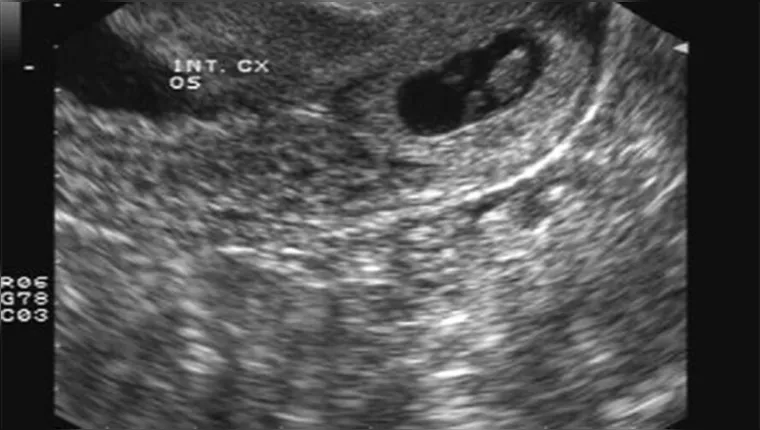 Imagem ilustrativa da notícia Vídeo: grávida descobre feto se desenvolvendo no fígado