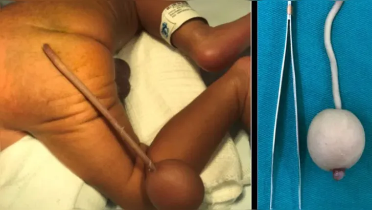 Imagem ilustrativa da notícia Caso raro: bebê nasce com "cauda" de 12cm no Brasil