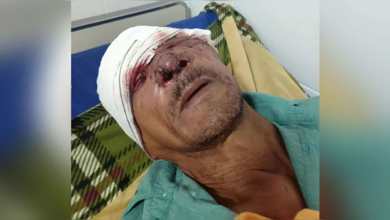 Imagem ilustrativa da notícia Idoso luta com onça no Marajó e fica com rosto desfigurado