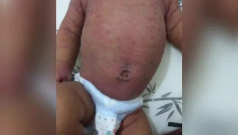 Imagem ilustrativa da notícia Médico dá alta para bebê em "carne viva" por causa da sarna