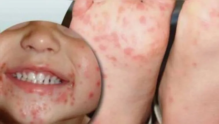 Imagem ilustrativa da notícia Entenda a doença contagiosa que atingiu crianças de 5 anos
