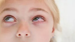 As crianças costumam levar as mãos aos olhos com mais frequência, o que pode causar a doença