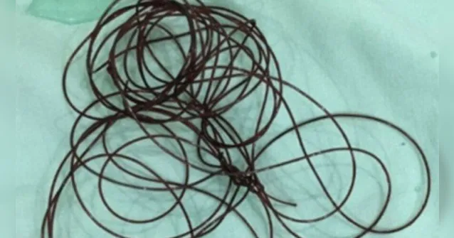 Imagem ilustrativa da notícia Homem é internado após enfiar nylon no pênis em masturbação