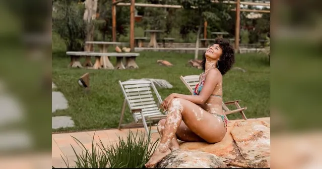 Imagem ilustrativa da notícia BBB22: Natália conta como descobriu vitiligo; há tratamento?