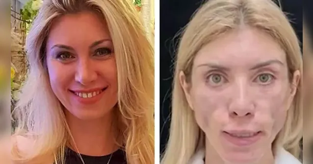Imagem ilustrativa da notícia Miss perde a capacidade de fechar os olhos após plástica