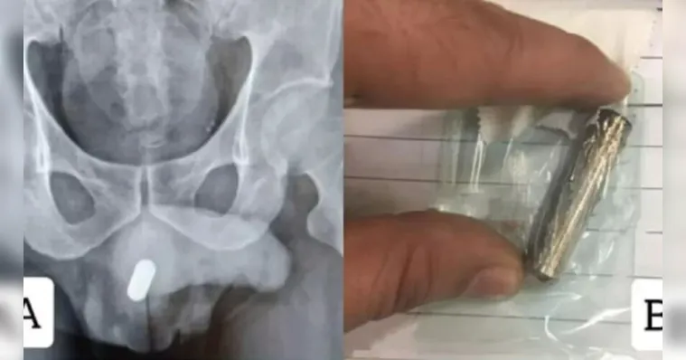Imagem ilustrativa da notícia Homem introduz pilha no pênis e fica 24 horas sem urinar