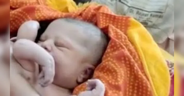 Imagem ilustrativa da notícia Deus? Bebê nasce com 4 braços e 4 pernas, veja o vídeo!
