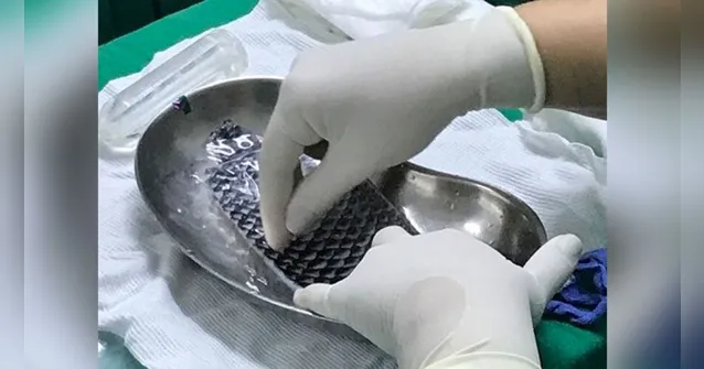 Imagem ilustrativa da notícia Mulheres têm canal vaginal reconstruído com pele de tilápia