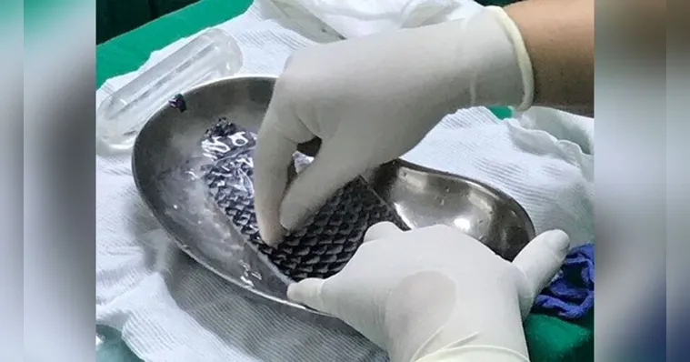 Imagem ilustrativa da notícia Mulheres têm canal vaginal reconstruído com pele de tilápia