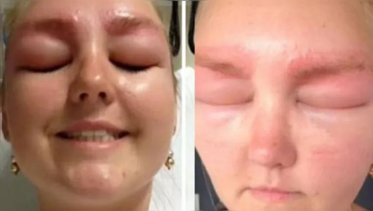 Imagem ilustrativa da notícia Vídeo: Jovem tem reação alérgica após procedimento estético 