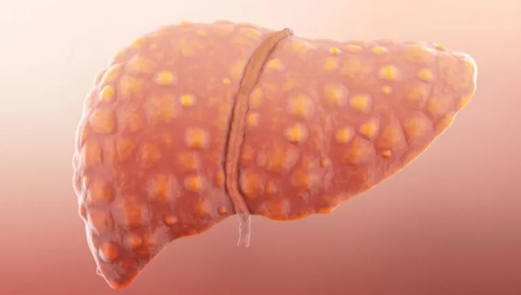 Imagem ilustrativa da notícia OMS monitora casos de hepatite de origem desconhecida