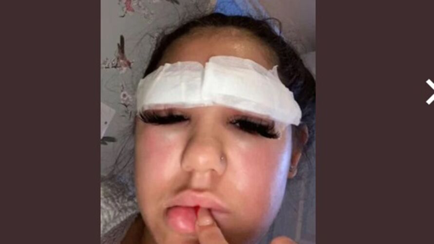 Ruby compartilhou as fotos do rosto inchado e vermelho nas redes sociais para alertar outras mulheres